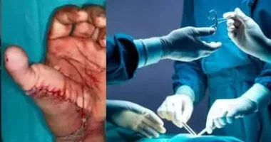 أطباء ينجحون في إعادة بناء إبهام شاب باستخدام إصبع من ساقه المبتورة